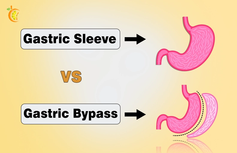 Gastric Sleeve vs. Gastric Bypass: Which One Is Right for You? Gastric Sleeve vs. Gastric Bypass