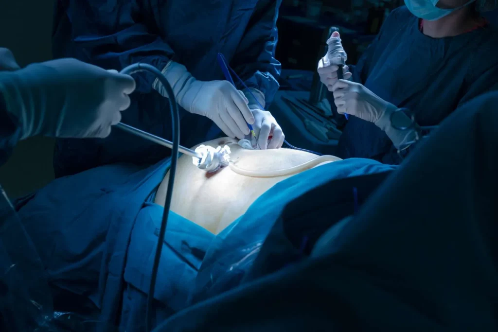Minimally Invasive Hernia Surgery